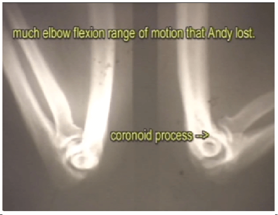 Dr. Mike Marshall Pitching Mechanics - Causes of Injuries