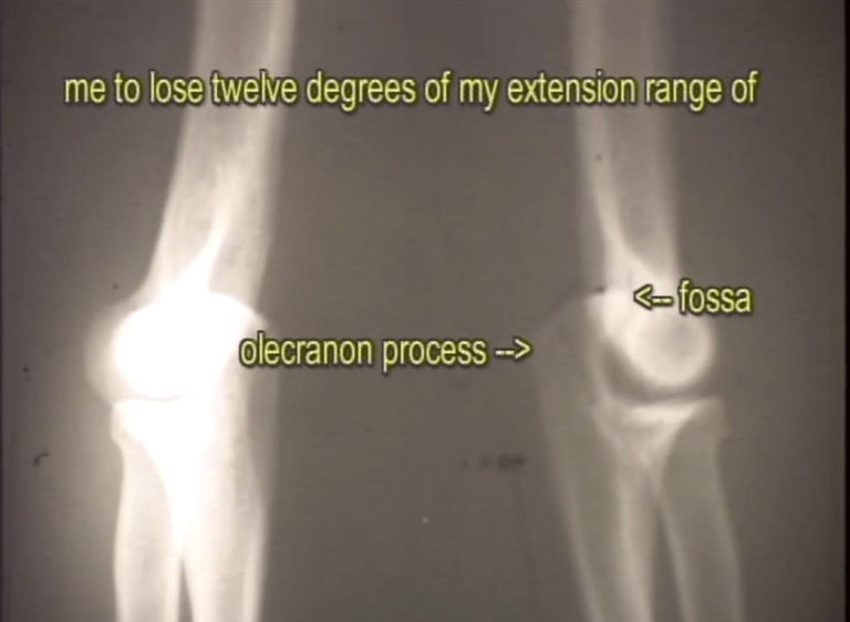 1967 X-ray of Dr. Mike Marshall’s elbows showing loss of extension in pitching arm—foundational to his biomechanics pitching reform philosophy.