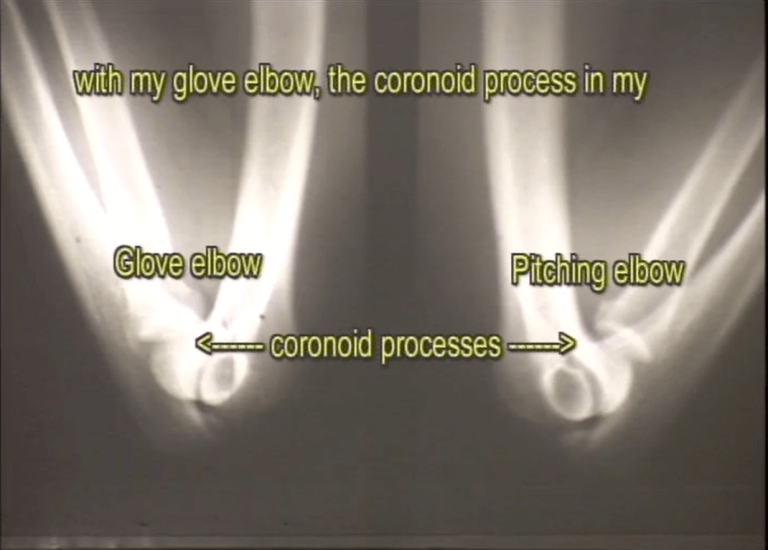 1967 X-ray of Dr. Mike Marshall’s elbows showing loss of flexion in pitching arm—documenting early-stage injury mechanics missed by feel-based coaching.